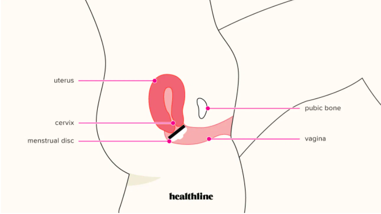 An illustration demonstrating the positioning of a menstrual disc behind the pubic bone inside the vagina